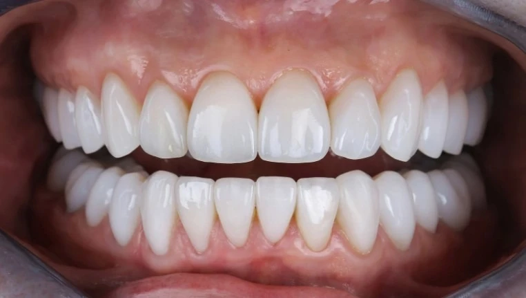 Неліктен тіс имплантациясы – тек сұлулық емес, денсаулық туралы да маңызды 3