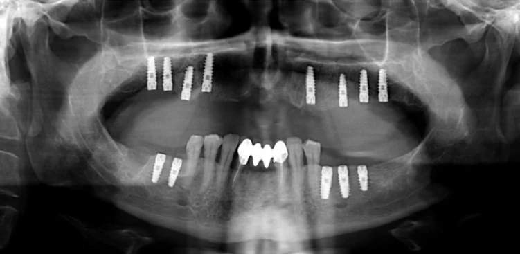 Неліктен тіс имплантациясы – тек сұлулық емес, денсаулық туралы да маңызды 5
